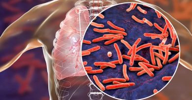 Минздрав Грузии: «Курс лечения резистентного туберкулеза продлится 6-ть месяцев вместо 20-ти»